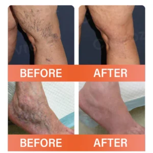 Oveallgo® VeinEase Microneedle Therapy Patch 9 Oveallgo® VeinEase Microneedle Therapy Patch