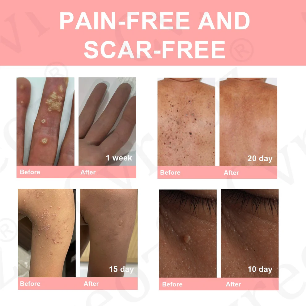 Fivfivgo® Dual Acid Wart & Mole Removal Serum 5 Fivfivgo® Dual Acid Wart & Mole Removal Serum