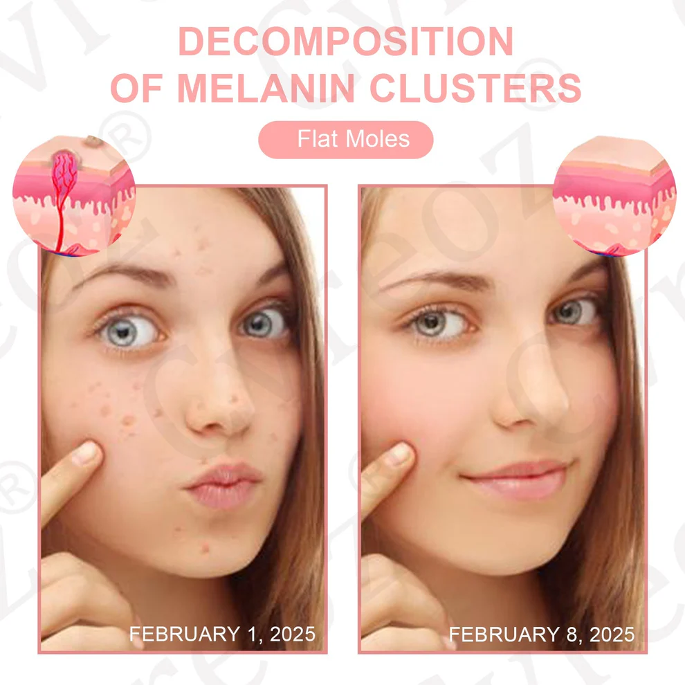 Fivfivgo® Dual Acid Wart & Mole Removal Serum 4 Fivfivgo® Dual Acid Wart & Mole Removal Serum