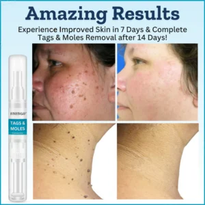 Fivfivgo™ Tags & Moles Corrector 9 Fivfivgo™ Tags & Moles Corrector