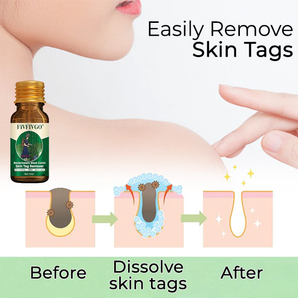 Fivfivgo® Bacteriostatic Black Cumin Skin Tag Remover 7 Fivfivgo® Bacteriostatic Black Cumin Skin Tag Remover