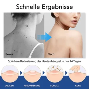 Fivfivgo® ClearTag Wart Remover: Seal & Heal Patches 11 Fivfivgo® ClearTag Wart Remover: Seal & Heal Patches