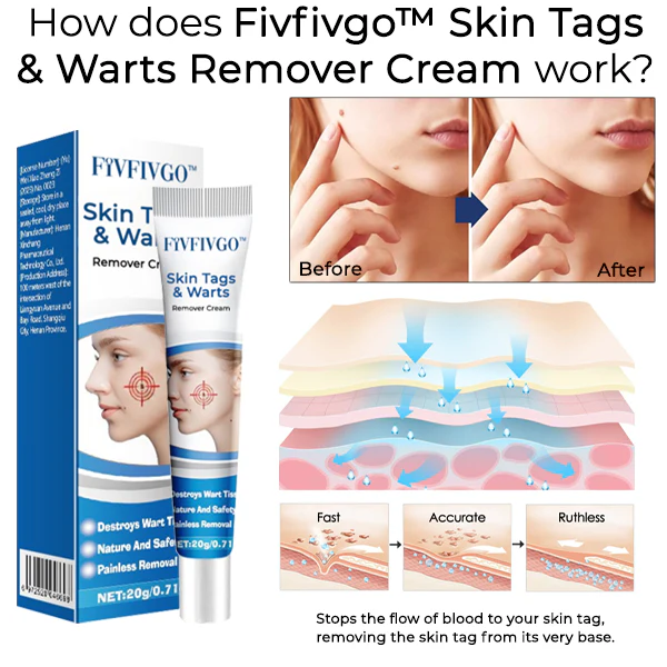 Fivfivgo™ Skin Tags & Warts Remover Cream 5 Fivfivgo™ Skin Tags & Warts Remover Cream