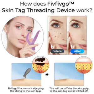 Fivfivgo™ Skin Tag Threading Device 5 Fivfivgo™ Skin Tag Threading Device