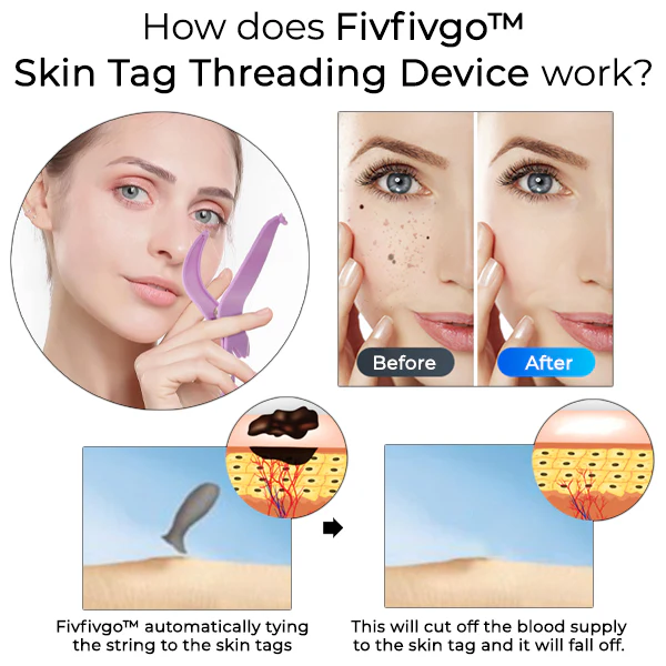 Fivfivgo™ Skin Tag Threading Device 3 Fivfivgo™ Skin Tag Threading Device