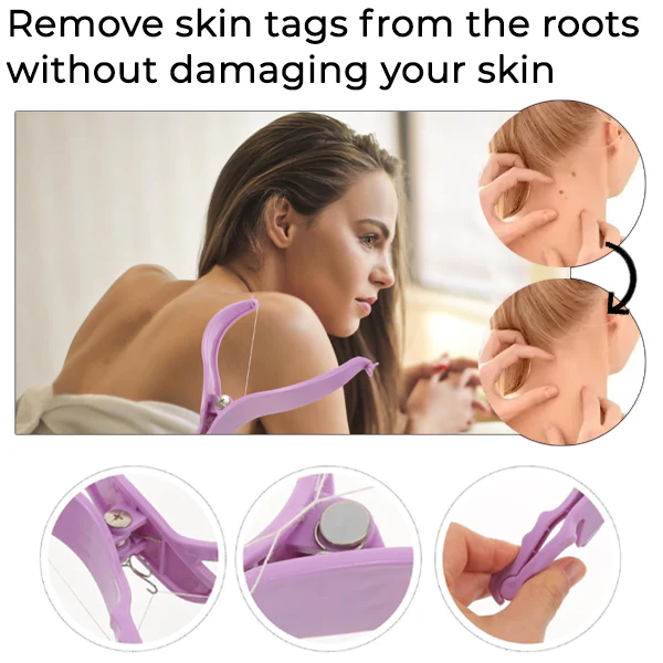 Fivfivgo™ Skin Tag Threading Device 2 Fivfivgo™ Skin Tag Threading Device