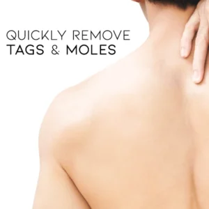 Fivfivgo™ WipeOff Tags & Mole Remover 5 Fivfivgo™ WipeOff Tags & Mole Remover