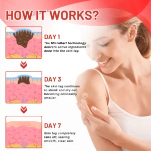 Fivfivgo® MicroDart Skin Tag Remover Patch 11 Fivfivgo® MicroDart Skin Tag Remover Patch
