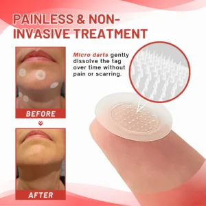 Fivfivgo® MicroDart Skin Tag Remover Patch 9 Fivfivgo® MicroDart Skin Tag Remover Patch