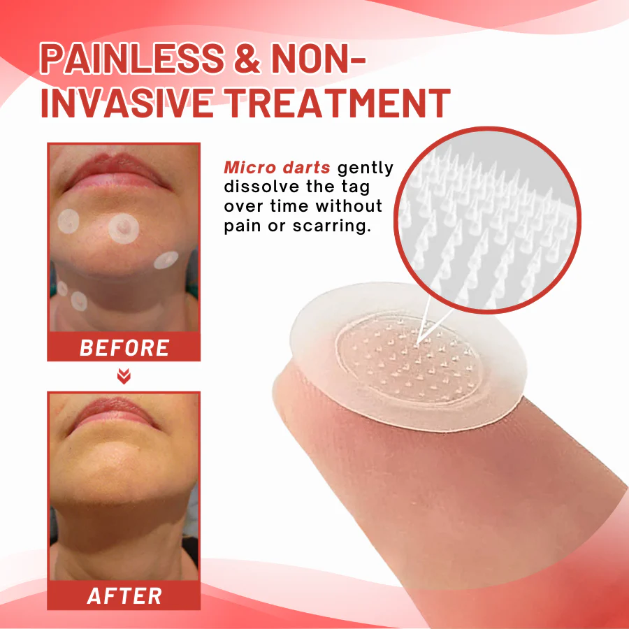 Fivfivgo® MicroDart Skin Tag Remover Patch 3 Fivfivgo® MicroDart Skin Tag Remover Patch