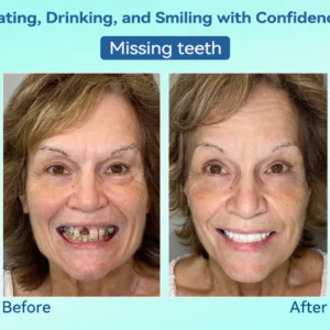 DIYSTAR™ Premium Denture