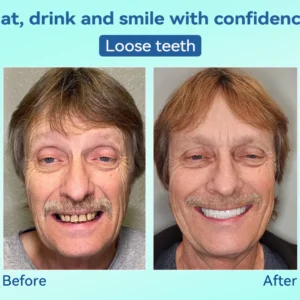 DIYSTAR™ Premium Denture