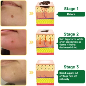 Fivfivgo™ 20% Salicylic Acid Skin Treatment Cream 20 Fivfivgo™ 20% Salicylic Acid Skin Treatment Cream