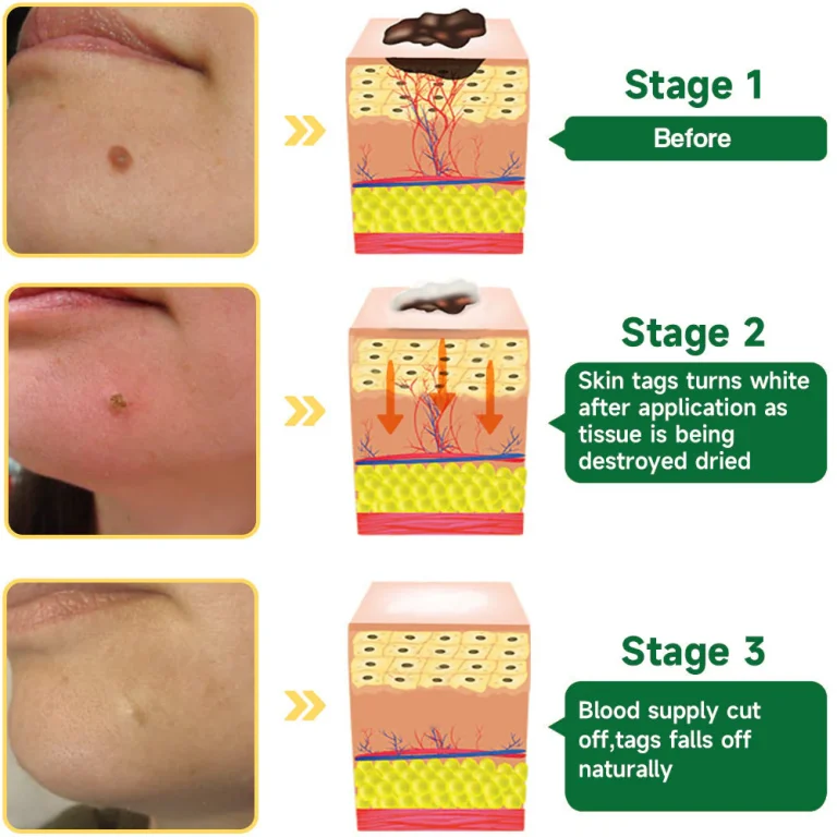 Fivfivgo™ 20% Salicylic Acid Skin Treatment Cream 10 Fivfivgo™ 20% Salicylic Acid Skin Treatment Cream