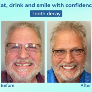 DIYSTAR™ Premium Denture