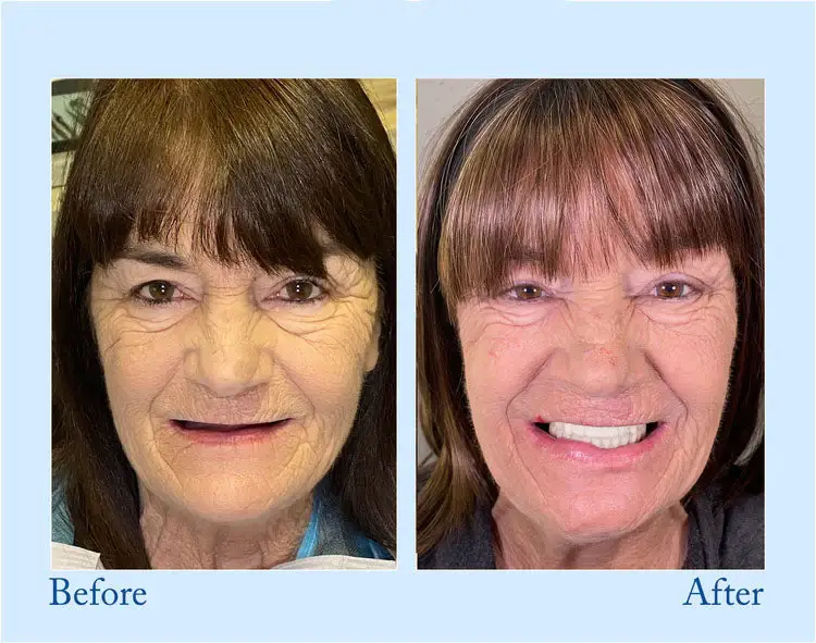 Hidone® Advanced Customized Full Denture Set 3 Hidone® Advanced Customized Full Denture Set