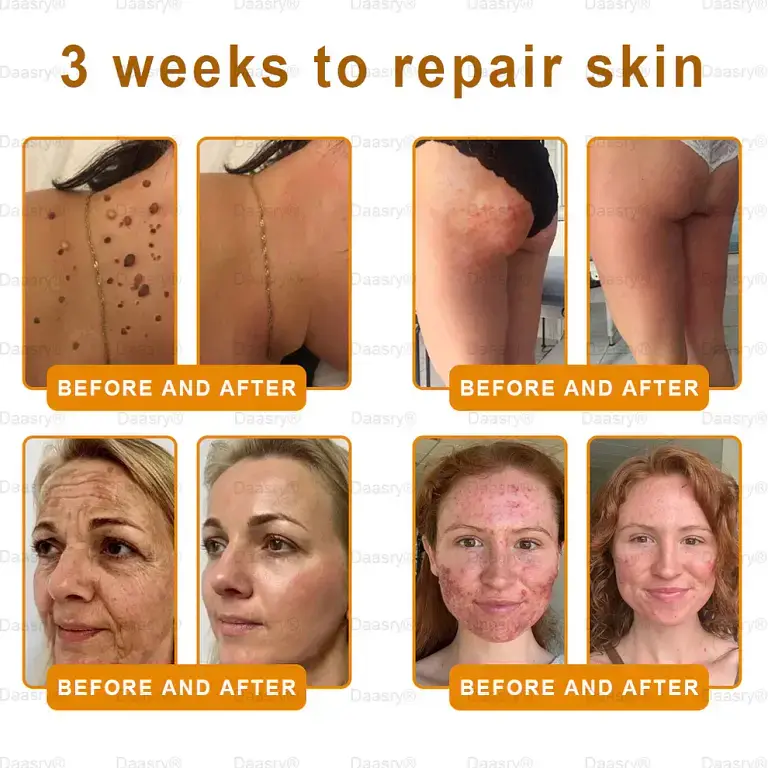 Daasry® “Dermal Gold” Botox Bee Venom Skin Restoration Cream 6 Daasry® “Dermal Gold” Botox Bee Venom Skin Restoration Cream