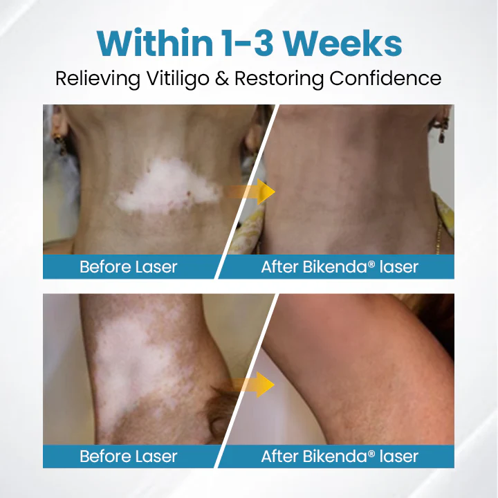 Bikenda® DermaBeam Vitiligo Therapy Device 4 Bikenda® DermaBeam Vitiligo Therapy Device