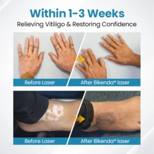 Bikenda® DermaBeam Vitiligo Therapy Device 9 Bikenda® DermaBeam Vitiligo Therapy Device
