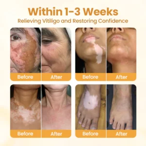 BBOJI™ VitiClear Pro Bee Toxin Cream 12 BBOJI™ VitiClear Pro Bee Toxin Cream