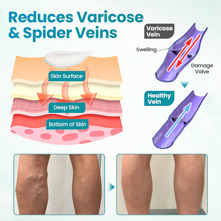 Fivfivgo® VeinEase Soothing Cream 4 Fivfivgo® VeinEase Soothing Cream