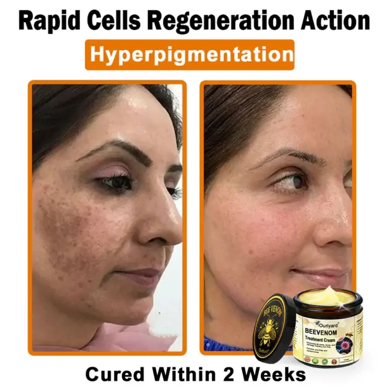 Ourlyard® Botulinum Toxin & Bee Venom Skin Treatment Cream 4 Ourlyard® Botulinum Toxin & Bee Venom Skin Treatment Cream