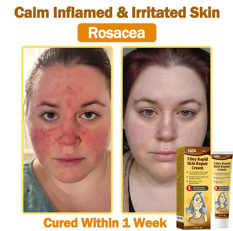 HZA7-Day Rapid Skin Repair Cream UK Dermatologist Approved 6 HZA7-Day Rapid Skin Repair Cream UK Dermatologist Approved