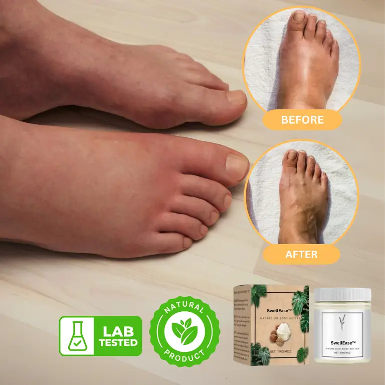 SwellEase™ Cream | Stop Aching Instantly & Eliminate 87% of Swelling in 9 Days 1 SwellEase™ Cream | Stop Aching Instantly & Eliminate 87% of Swelling in 9 Days