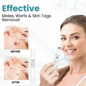 DermaZap™ Non-Invasive Mole and Wart Removal Laser Pen 12 DermaZap™ Non-Invasive Mole and Wart Removal Laser Pen