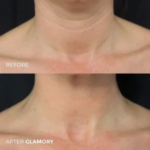 Glamory The MicroLift