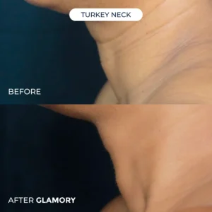 Glamory The MicroLift