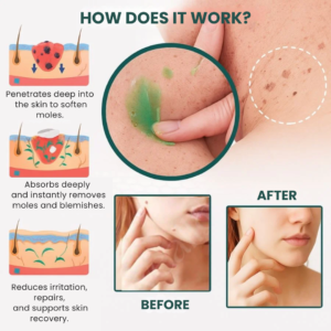 SilkSkin™ | Clinically Proven to Remove 97% of Moles, Warts & Blemishes – Permanently in Just 3 Days!
