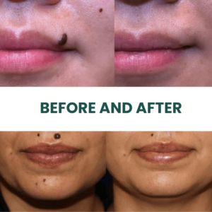 SilkSkin™ | Clinically Proven to Remove 97% of Moles, Warts & Blemishes – Permanently in Just 3 Days!