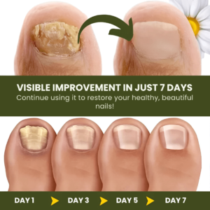 NailCure™ Fungal Nail Drops | Removes 90% of Nail Fungus in 7 Days