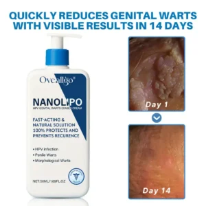 Oveallgo® NanoLipo HPV Genital Warts Eraser Cream 13 Oveallgo® NanoLipo HPV Genital Warts Eraser Cream