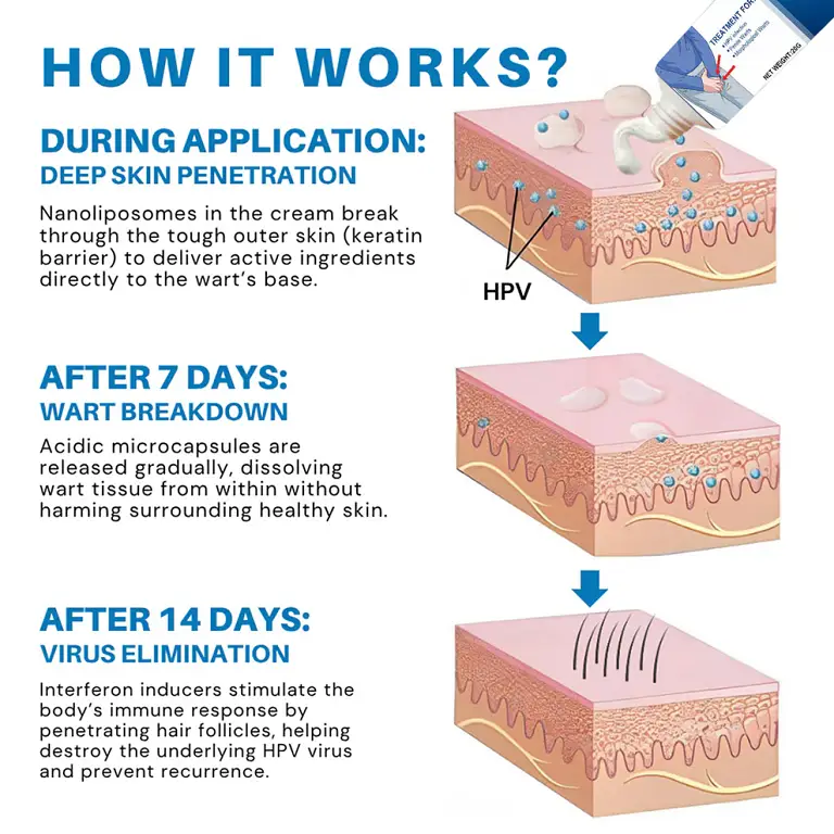 Cvreoz® HPV Genital Warts Relief Cream 5 Cvreoz® HPV Genital Warts Relief Cream