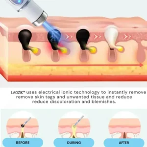 LAOZIK® Non-Invasive Mole and Wart Removal Laser Pen 15 LAOZIK® Non-Invasive Mole and Wart Removal Laser Pen