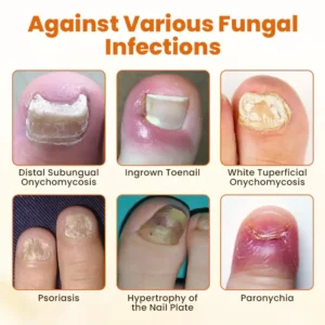 Timilk® FungiBee Advanced Nail Repair Spray 10 Timilk® FungiBee Advanced Nail Repair Spray