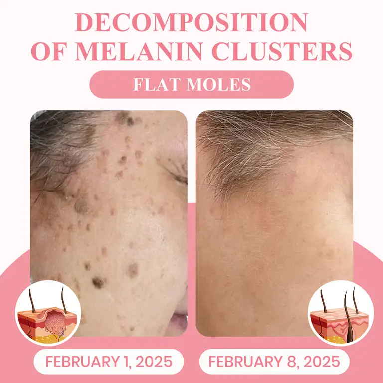 LUHAKA® Dual Acid Wart & Mole Removal Serum 7 LUHAKA® Dual Acid Wart & Mole Removal Serum