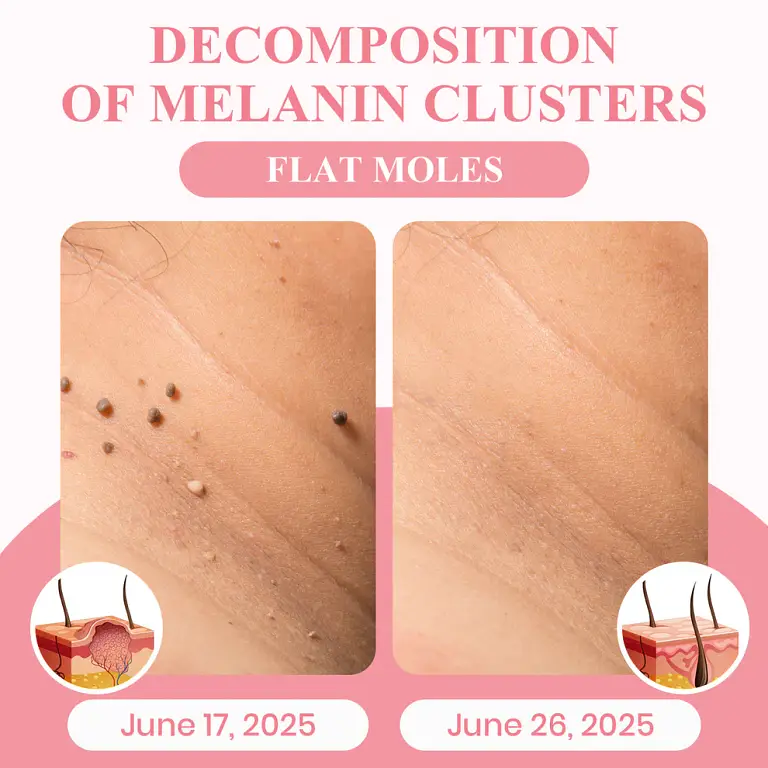 LUHAKA® Dual Acid Wart & Mole Removal Serum 9 LUHAKA® Dual Acid Wart & Mole Removal Serum