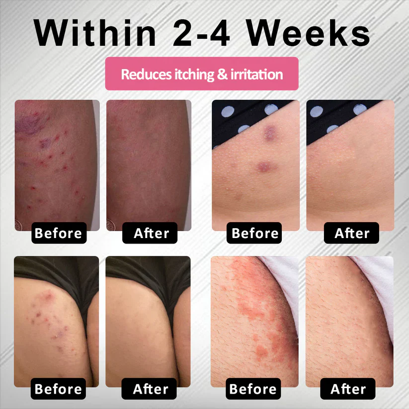 Fivfivgo® Female HPV Genital Wart Caring Spray 9 Fivfivgo® Female HPV Genital Wart Caring Spray