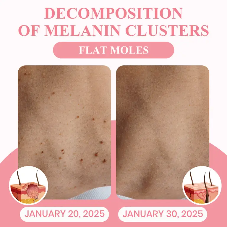 LUHAKA® Dual Acid Wart & Mole Removal Serum 8 LUHAKA® Dual Acid Wart & Mole Removal Serum