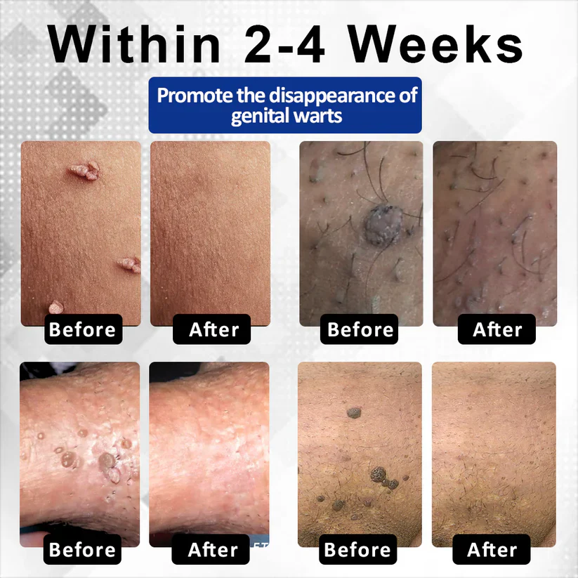 Fivfivgo® ManGuard HPV WART Healing Cream 5 Fivfivgo® ManGuard HPV WART Healing Cream