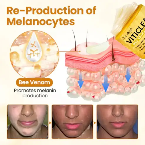 Oveallgo® VitiClear Pro Bee Venom Cream 10 Oveallgo® VitiClear Pro Bee Venom Cream