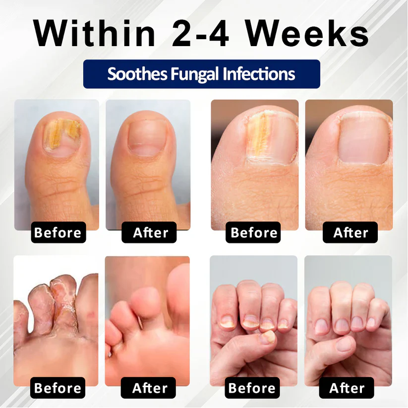 Fivfivgo® Fungiclear Bee Therapy Nail Spray 12 Fivfivgo® Fungiclear Bee Therapy Nail Spray