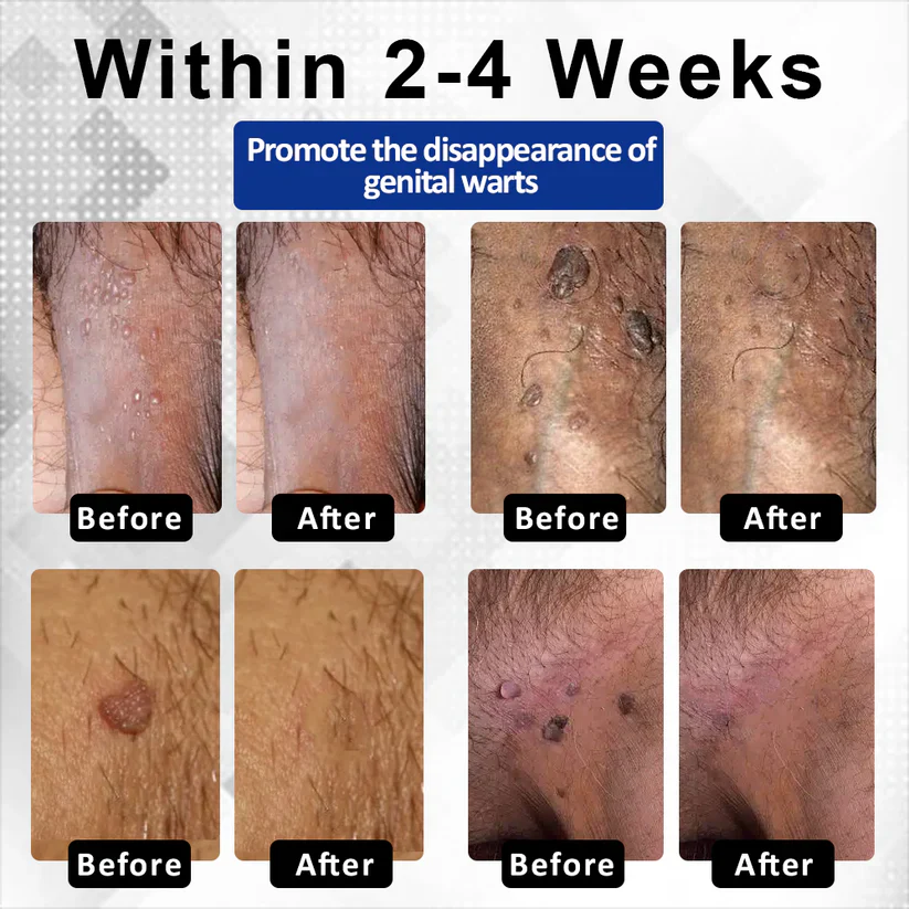 Fivfivgo® ManGuard HPV WART Healing Cream 4 Fivfivgo® ManGuard HPV WART Healing Cream