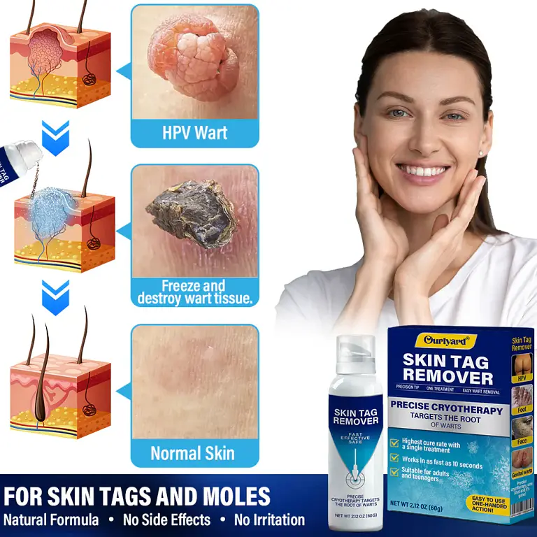 Ourlyard® TagRecede Cryo Treatment Spray 3 Ourlyard® TagRecede Cryo Treatment Spray