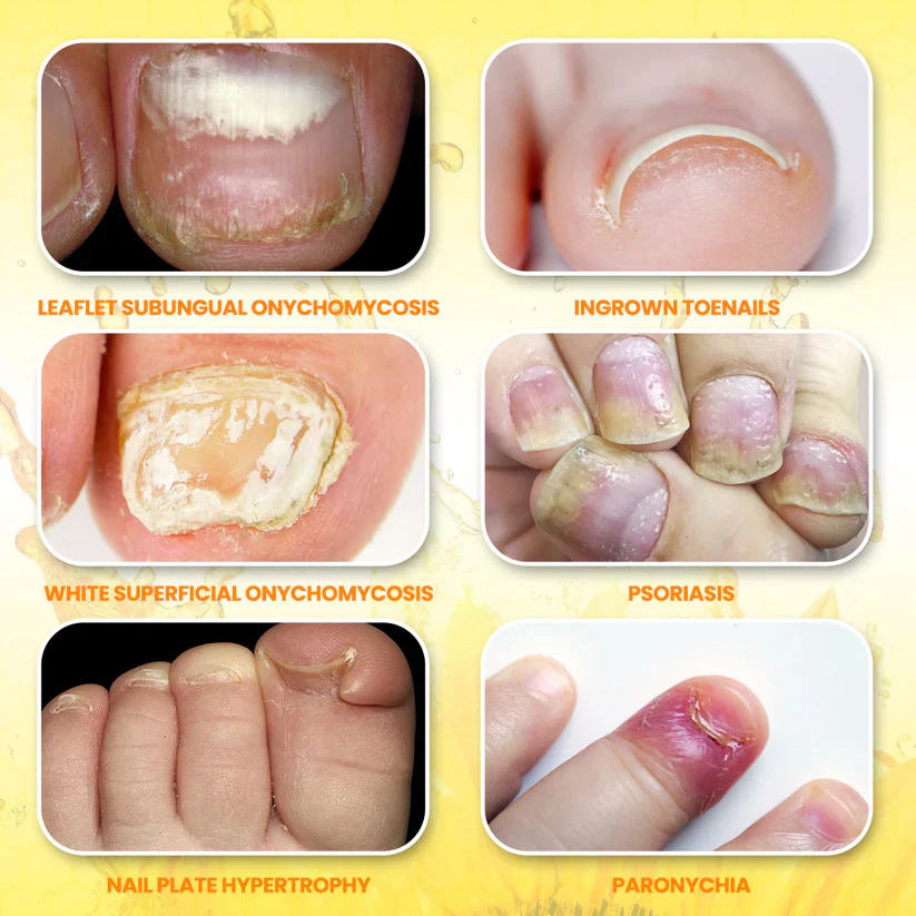 Fivfivgo® ClariNail Bee Venom Fungal Solution Drops 7 Fivfivgo® ClariNail Bee Venom Fungal Solution Drops