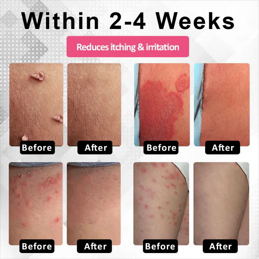 Fivfivgo® Woman's Genital HPV Healing Cream 11 Fivfivgo® Woman's Genital HPV Healing Cream