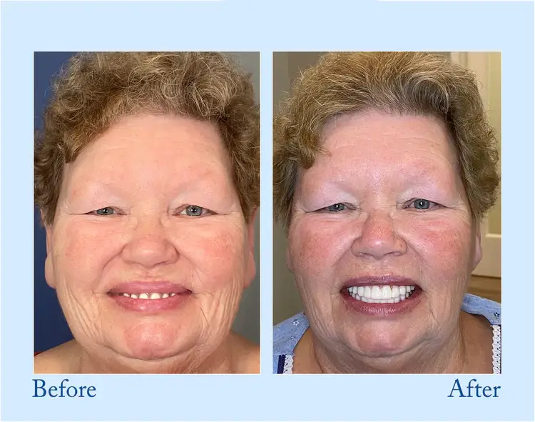 Hidone® Advanced Customized Full Denture Set 11 Hidone® Advanced Customized Full Denture Set